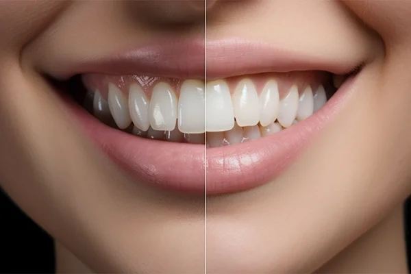 Clareamento dental dra odonto